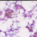 Ανάμεσα σε λιπώδη και συνδετικό ιστό ,αδενικά κύτταρα με διογκωμένουνς ανισομεγέθεις πηρήνες. Χρώση κατά Papanicolaou, μεγέθυνση 10Χ40. 